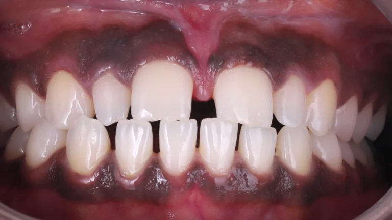 Aline Specialists | Orthodontists in Winchester