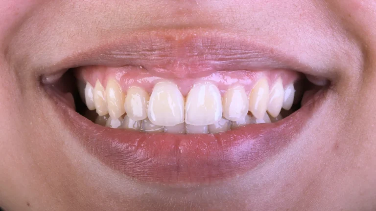 Aline Specialists | Orthodontists in Winchester