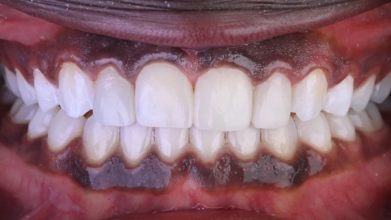 Aline Specialists | Orthodontists in Winchester