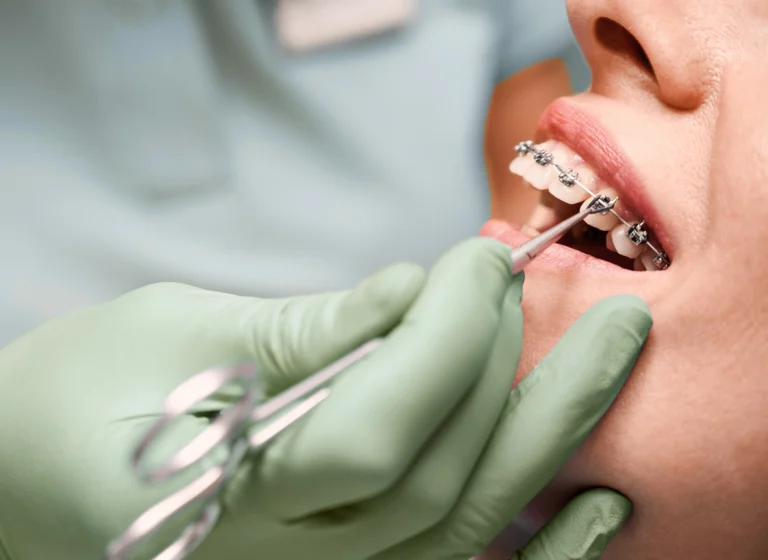 Blog 1 How Does a Brace Work