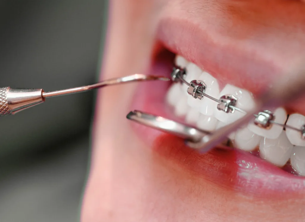 Brush Your Teeth with Fixed Braces