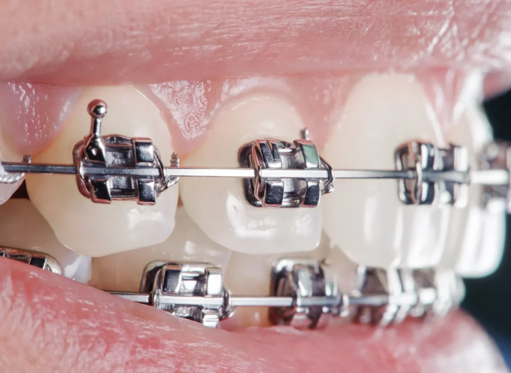 Brush Your Teeth with Fixed Braces