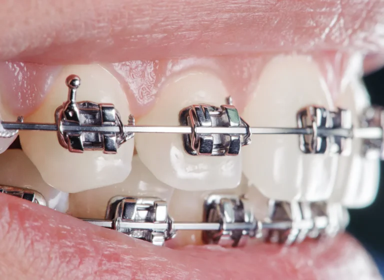 Brush Your Teeth with Fixed Braces