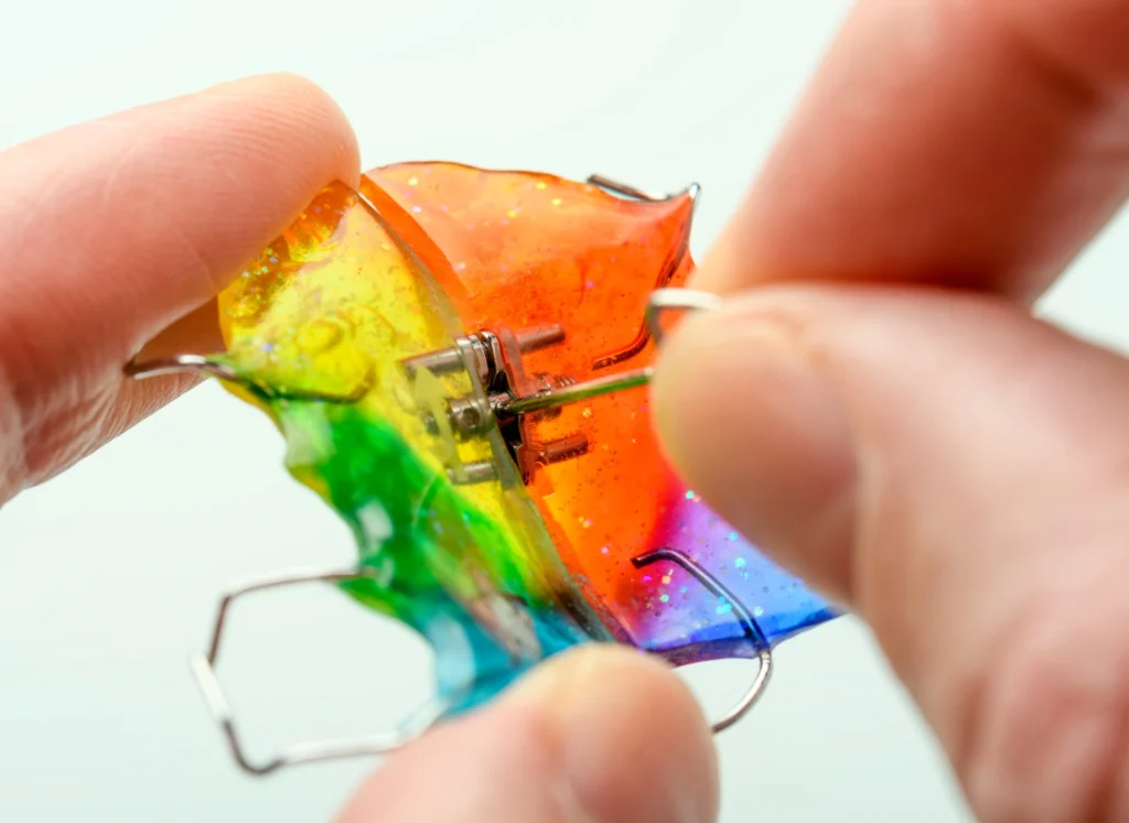Palatal Expander for Children 1 Palatal Expander for Children