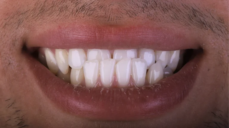Aline Specialists | Orthodontists in Winchester