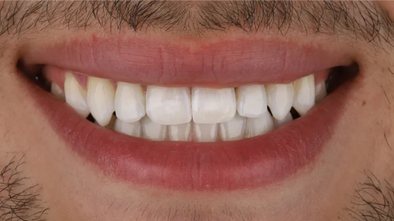 Aline Specialists | Orthodontists in Winchester