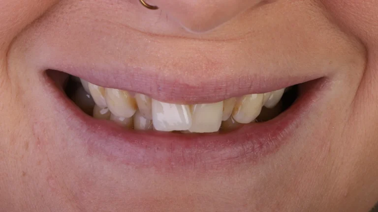 Aline Specialists | Orthodontists in Winchester