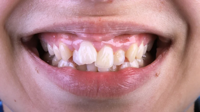 Aline Specialists | Orthodontists in Winchester